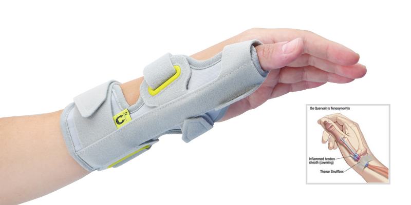 Using Thumb Splints to Treat De Quervain’s - Updated 2024