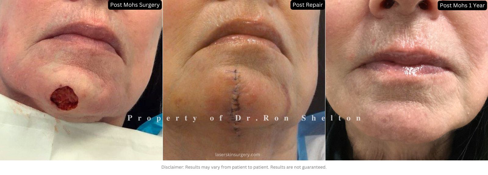 Mohs surgery on the chin after 1 year