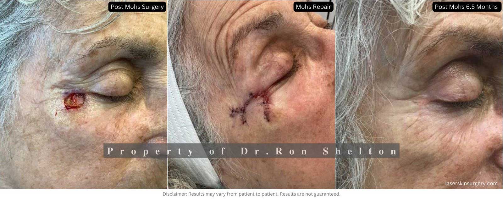 Post Mohs surgery 6.5 Months