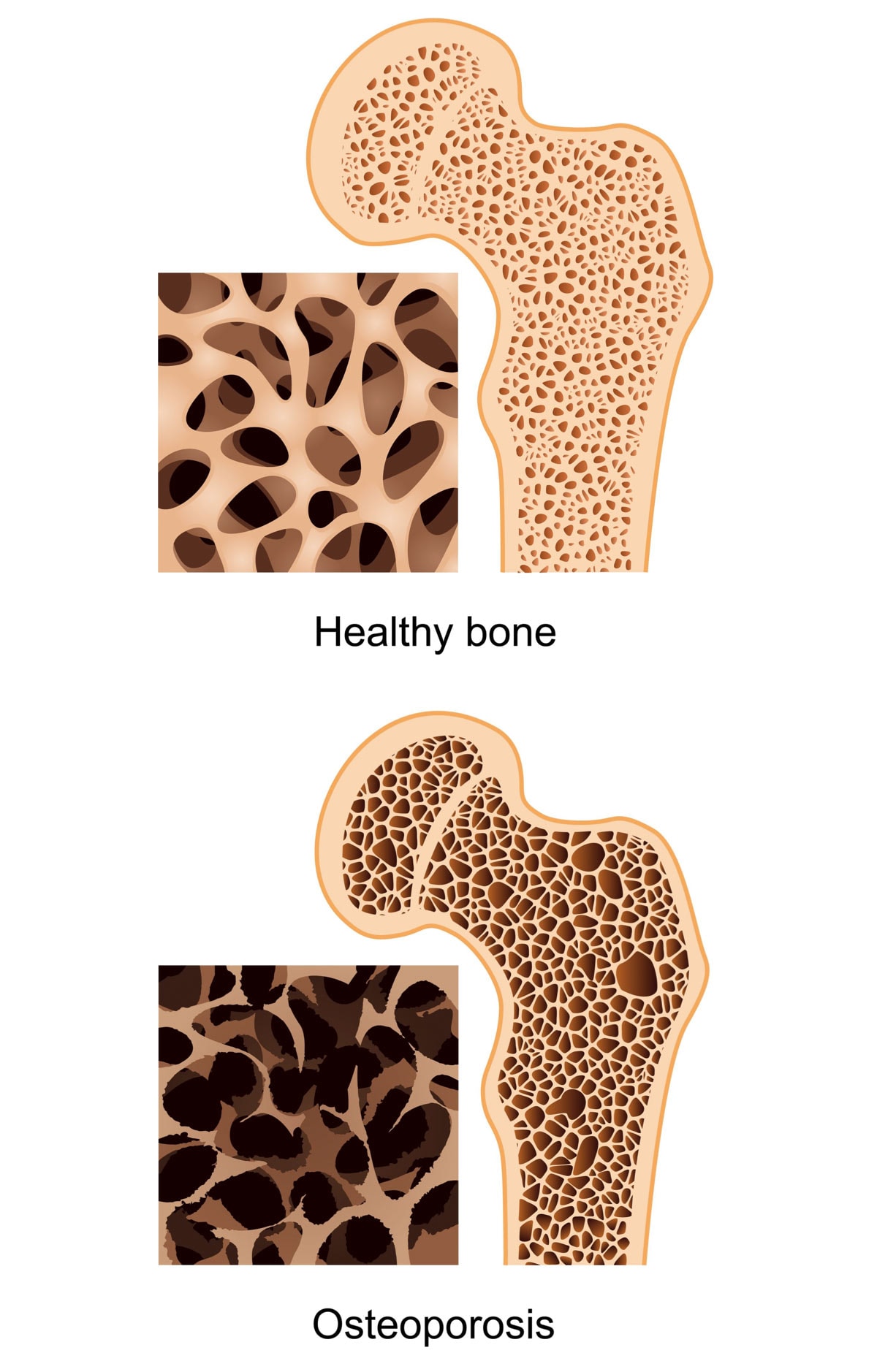 Understanding Osteoporosis