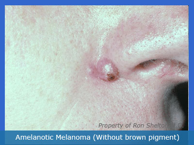 Melanoma