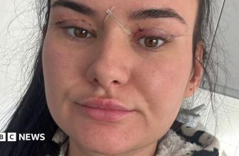 Open wounds and eyes that can’t close – women warn about cheap bleph eyelid surgery