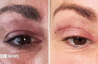Watch: ‘My eyelids became infected – I was scared to sleep’