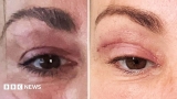 Watch: ‘My eyelids became infected – I was scared to sleep’
